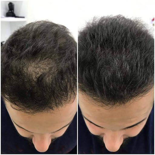 Before and After: A Journey Through Scalp Micropigmentation (SMP)