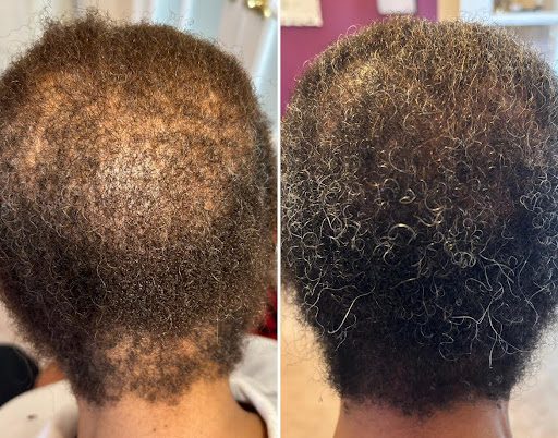 A Case Study: Helping a Woman with Multiple Types of Alopecia
