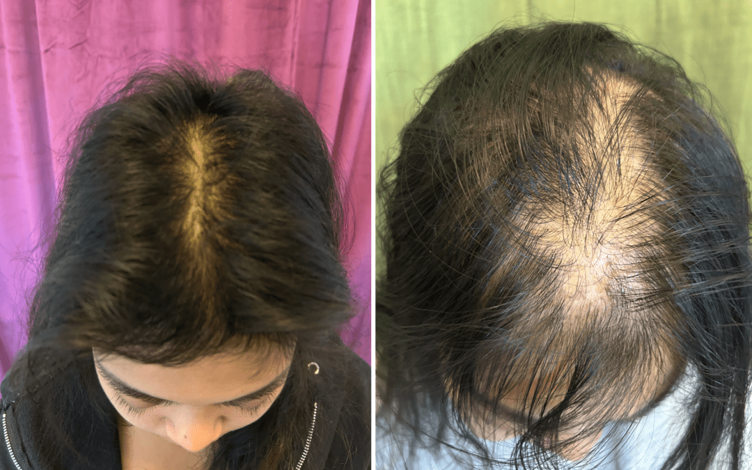 Before and After: How a 21-Year-Old Woman Recovered from Alopecia Areata