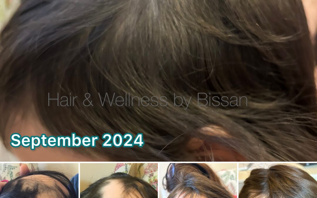 Before and After: The Heartwarming Journey of a 3-Year-Old Girl with Alopecia Areata