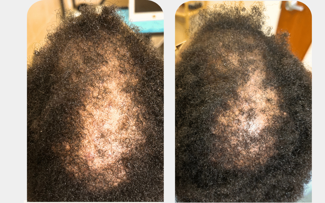 Traction Alopecia: How to Reverse Tension-Induced Hair Loss with a Functional and Trichology-Based Approach