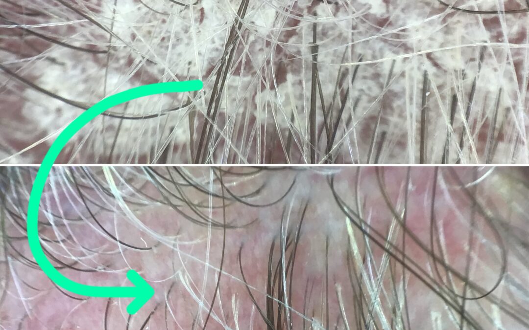 Scalp Conditions and Hair Loss: Functional Medicine and Trichology Approaches to Healing the Root