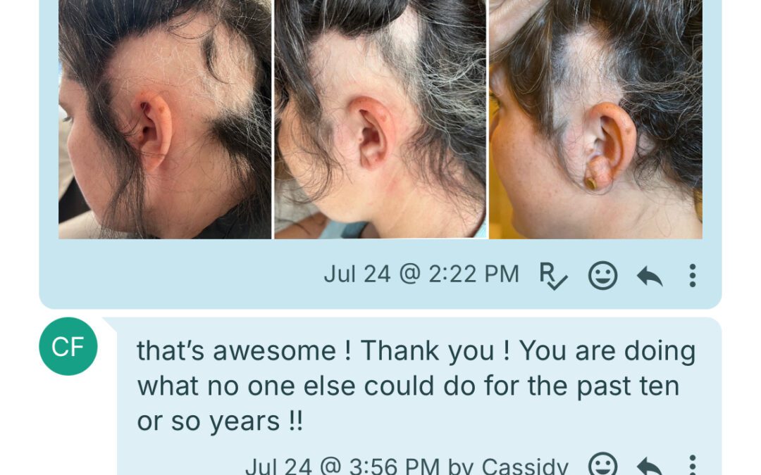 Alopecia Areata: A Functional Medicine and Trichology-Based Approach to an Autoimmune Hair Loss Condition