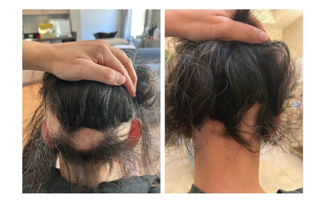 Case Study: Integrative Management of Alopecia Areata Ophiasis Associated with Toxicity, Fungal Infections, and Immune Dysfunction