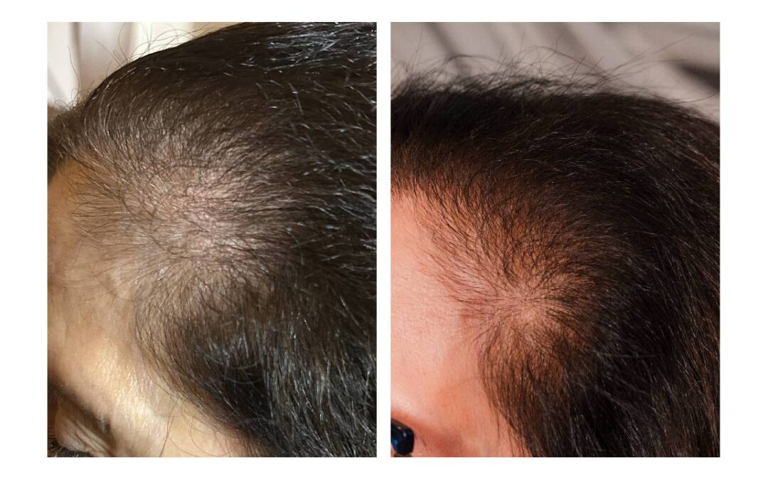 Case Study: Integrative Management of Hair Loss Risk in a Client on GLP-1 Therapy