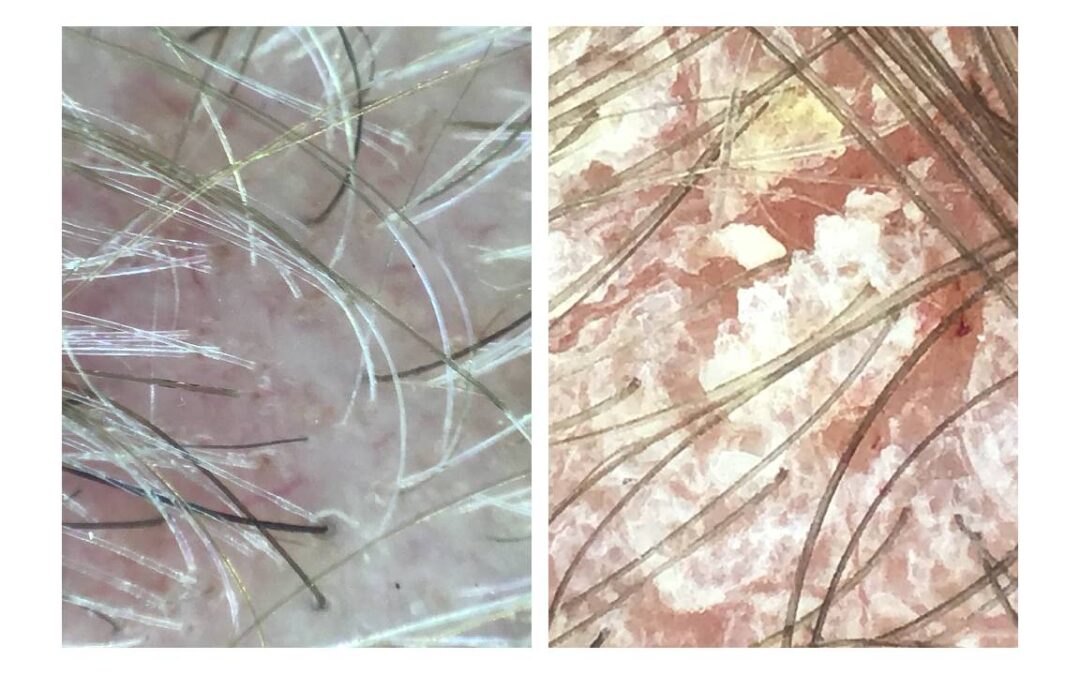 How to Tell the Difference Between Scalp Psoriasis, Seborrheic Dermatitis, and Dandruff