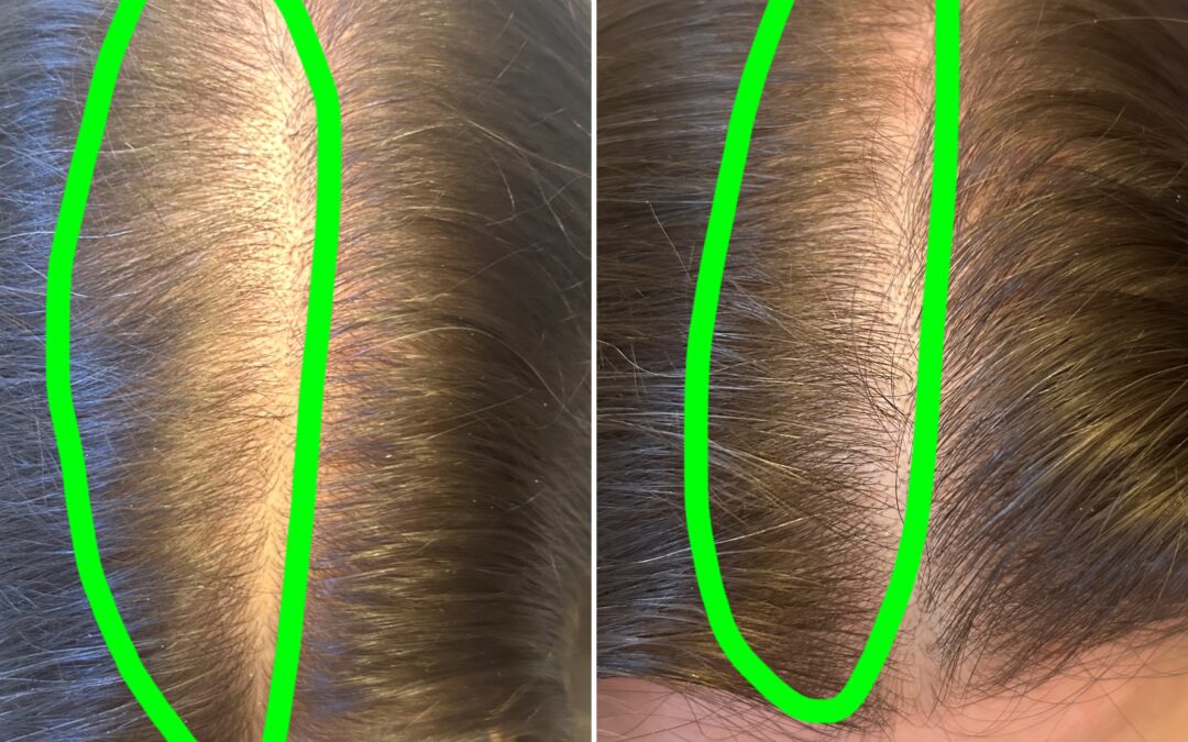 Why Is My Hair Shedding After Starting Weight Loss or a New Diet?