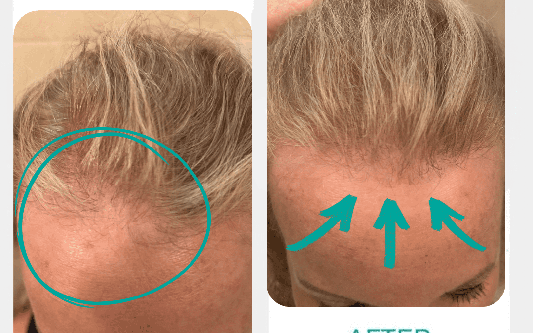 Does Ozempic Cause Hair Loss? Understanding Hair Shedding on GLP-1 Medications