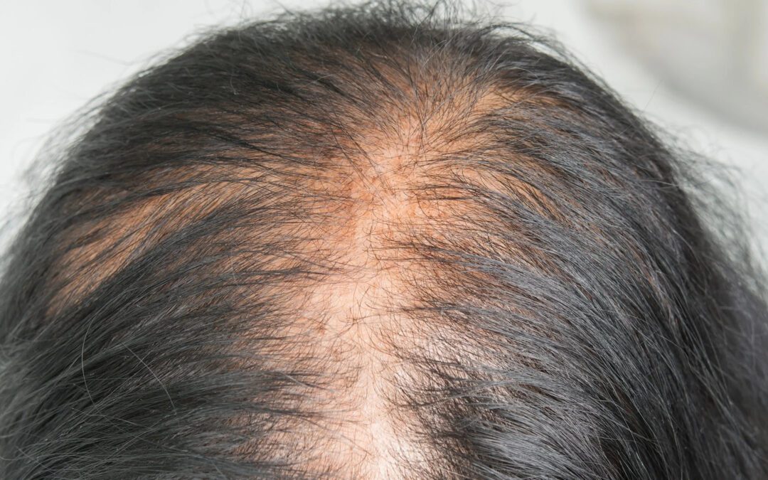 Why Is My Hair Falling Out in Spring? Causes of Seasonal Hair Loss Explained