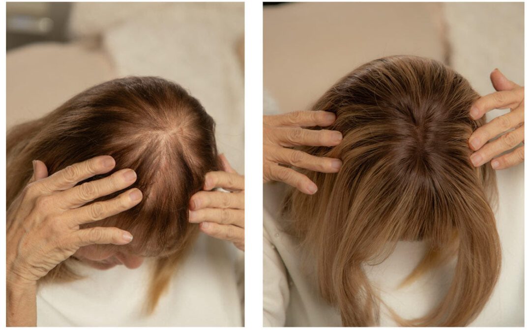 Hormonal Hair Loss in Women: A Functional and Clinical Perspective
