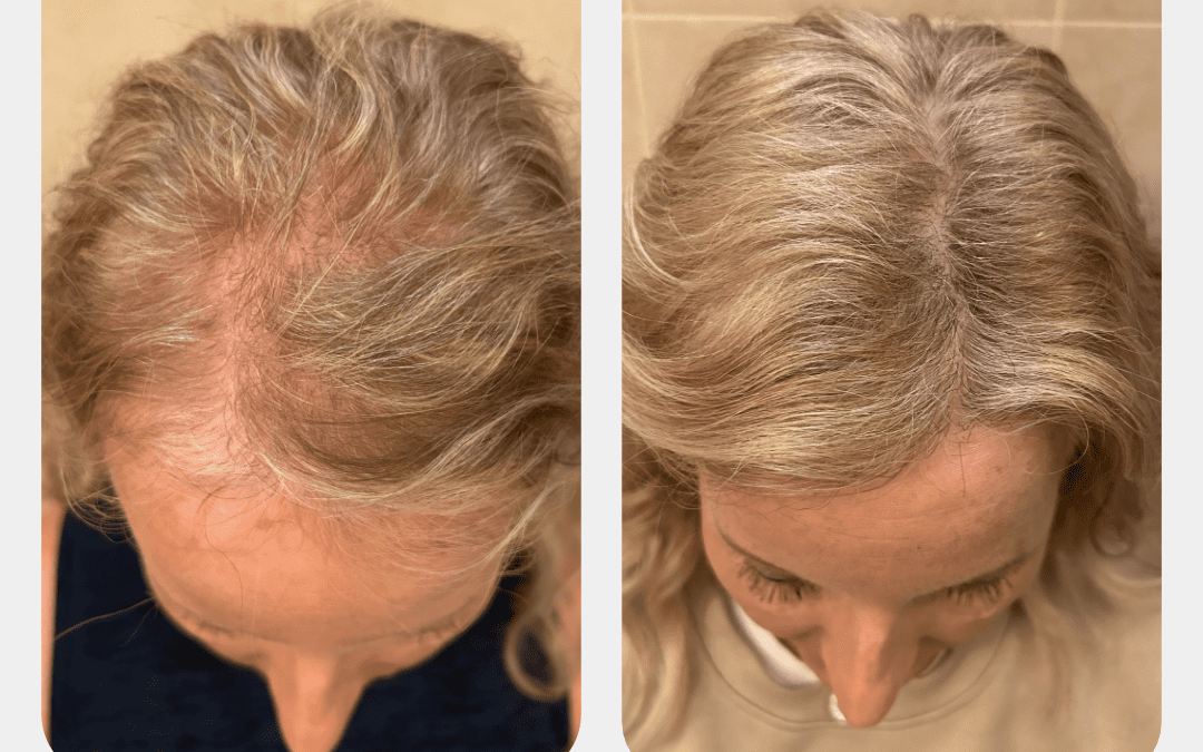 Ozempic and Hair Loss: What Is Really Causing the Shedding?