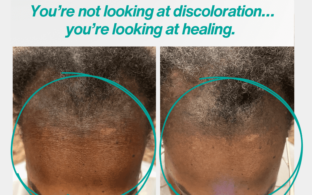 The Science Behind Scalp Hyperpigmentation in CCCA